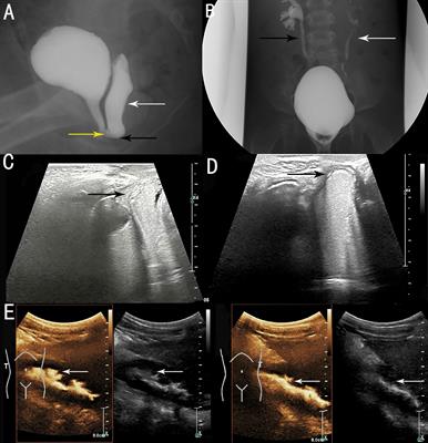 Congenital vaginal obstruction in a female with Cornelia de Lange syndrome: A case report